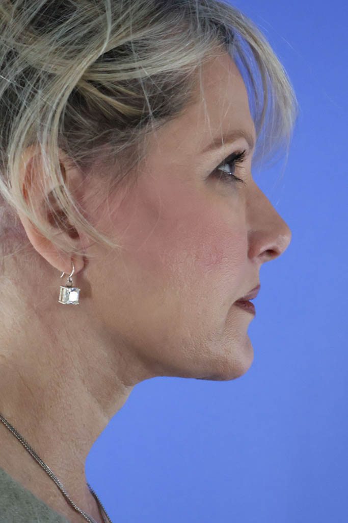 Facelift result at Platinum Plastic Surgery