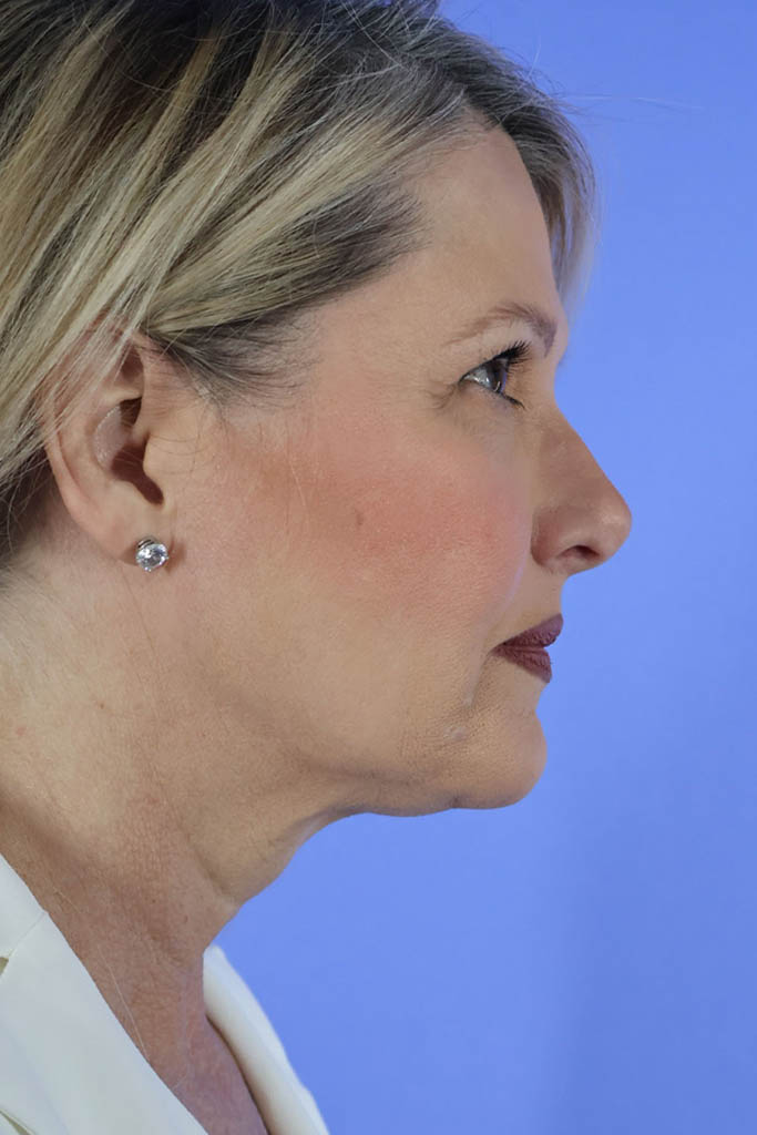 Facelift before photo