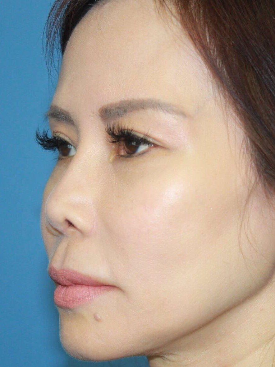 Rhinoplasty before photo