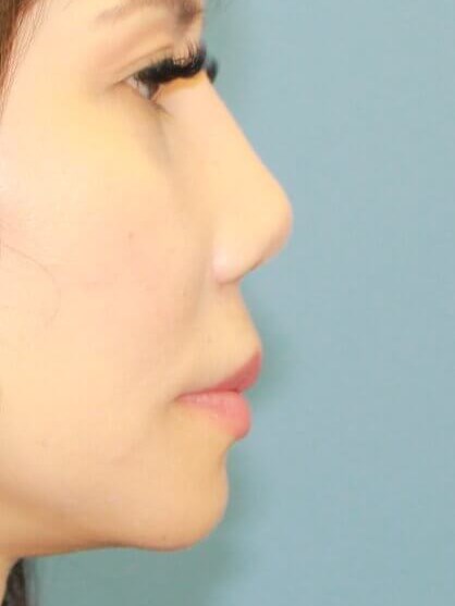 Rhinoplasty result at Platinum Plastic Surgery
