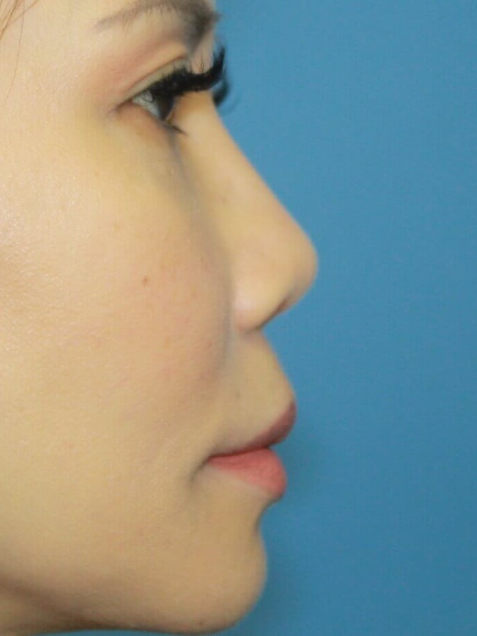 Rhinoplasty before photo