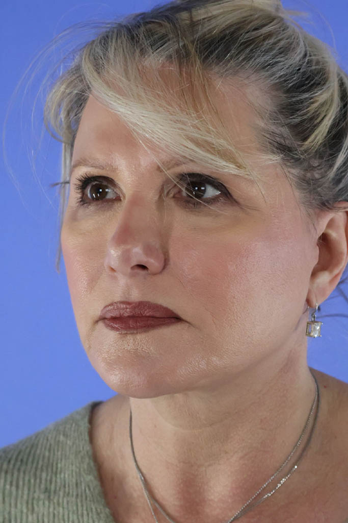 Facelift result at Platinum Plastic Surgery