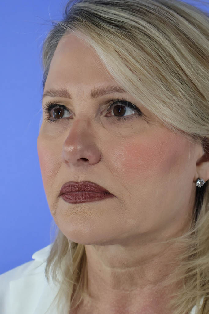Facelift before photo