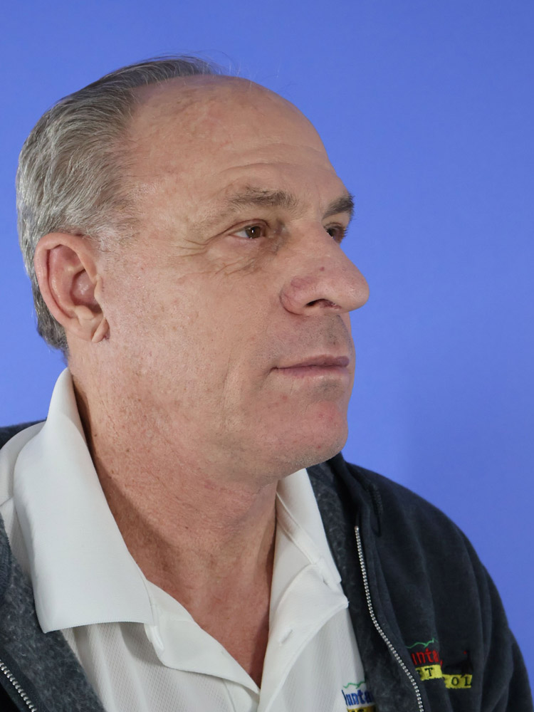 Facelift result at Platinum Plastic Surgery