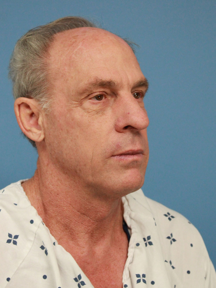 Facelift before photo