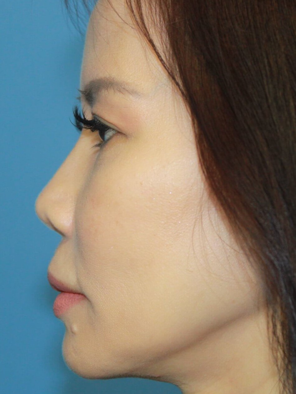 Rhinoplasty before photo