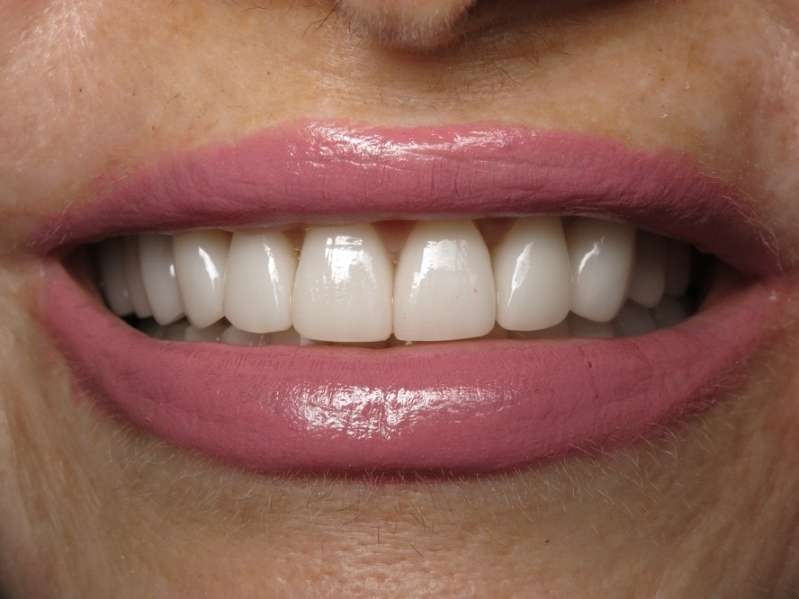 A result from Smile by Design Dental Group