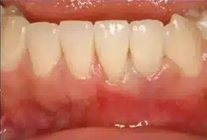 A result from Smile by Design Dental Group