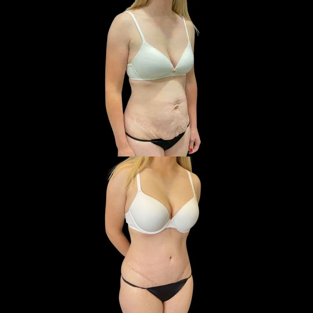 Real You Plastic Surgery mommy makeover after — American Fork, UT