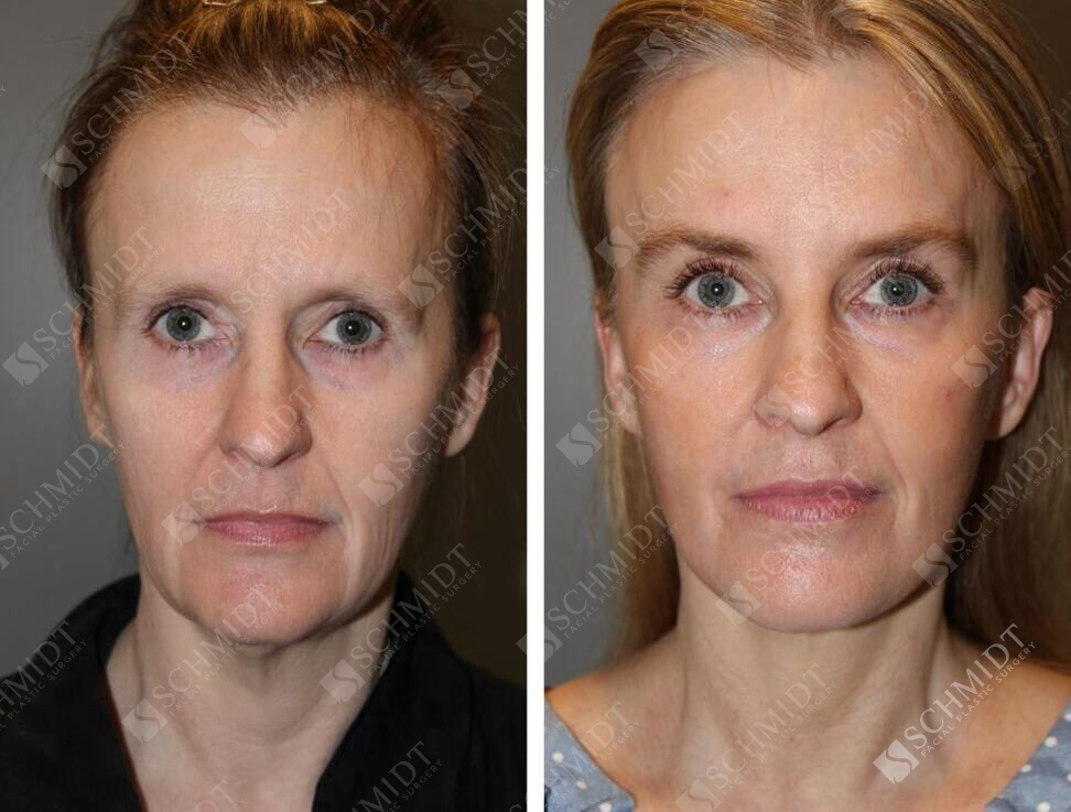 A result from Schmidt Plastic Surgery