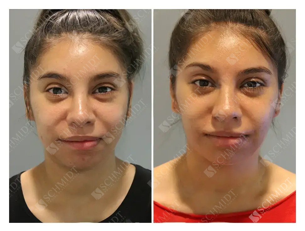 A result from Schmidt Plastic Surgery