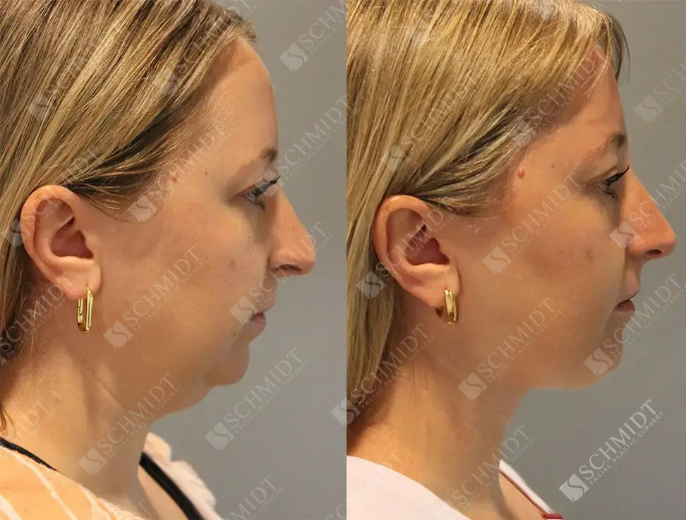 A result from Schmidt Plastic Surgery