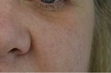 A result from Plastic Surgery, Pittsburgh PA: Dr. Anna Wooten, Beleza Plastic Surgery & Med Spa