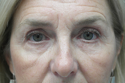 A result from Plastic Surgery, Pittsburgh PA: Dr. Anna Wooten, Beleza Plastic Surgery & Med Spa