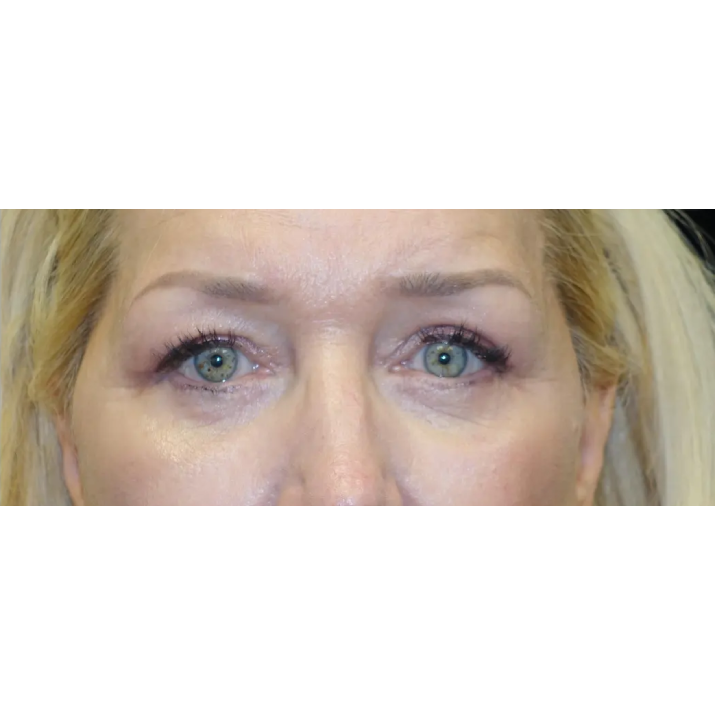 A result from Plastic Surgery, Pittsburgh PA: Dr. Anna Wooten, Beleza Plastic Surgery & Med Spa