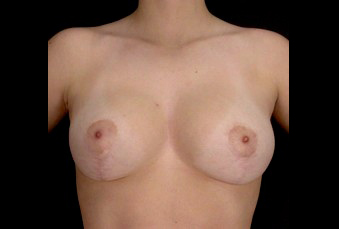 A result from Plastic Surgery, Pittsburgh PA: Dr. Anna Wooten, Beleza Plastic Surgery & Med Spa