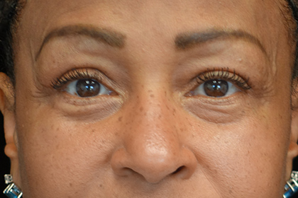 A result from Plastic Surgery, Pittsburgh PA: Dr. Anna Wooten, Beleza Plastic Surgery & Med Spa
