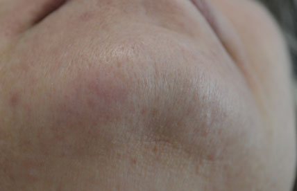 A result from Plastic Surgery, Pittsburgh PA: Dr. Anna Wooten, Beleza Plastic Surgery & Med Spa
