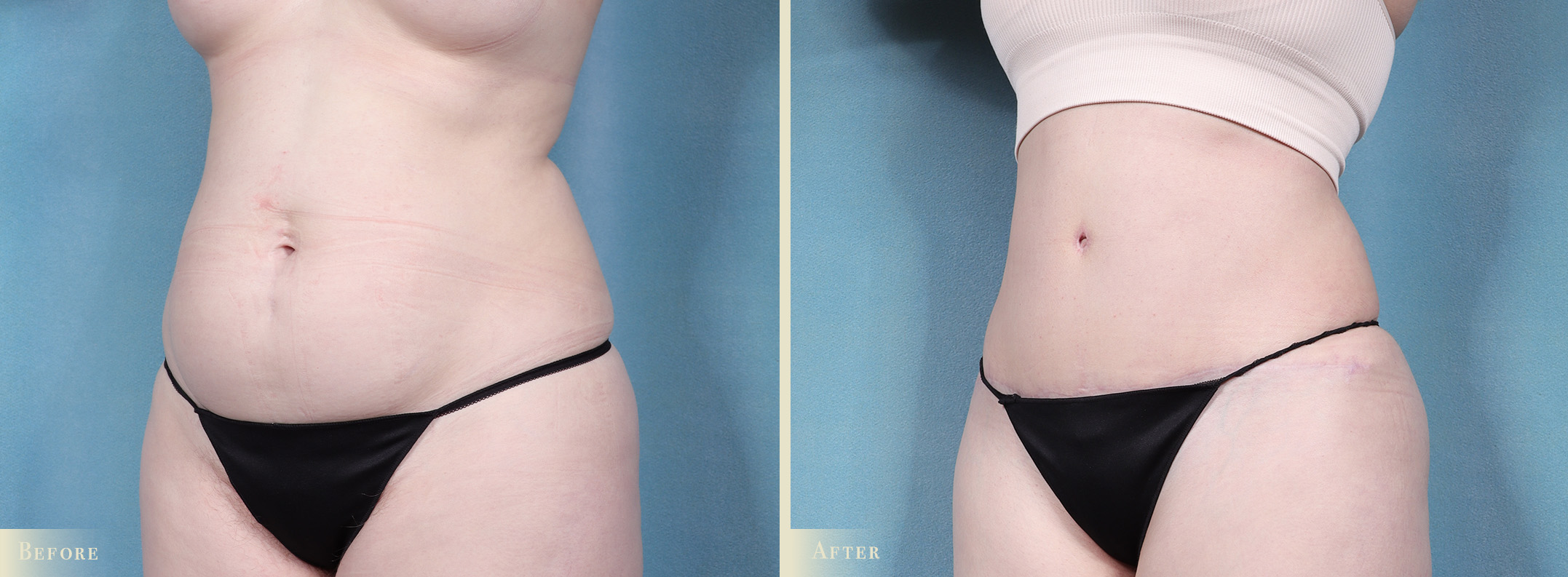 A result from Colorado Plastic Surgery