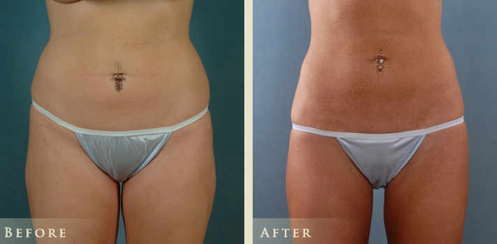 A result from Colorado Plastic Surgery