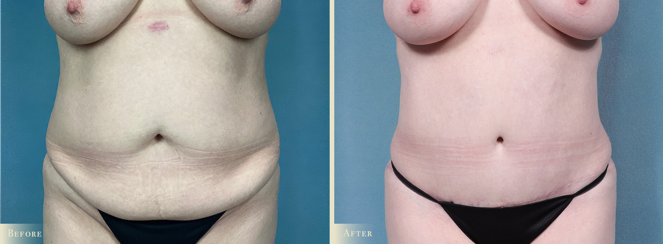 A result from Colorado Plastic Surgery