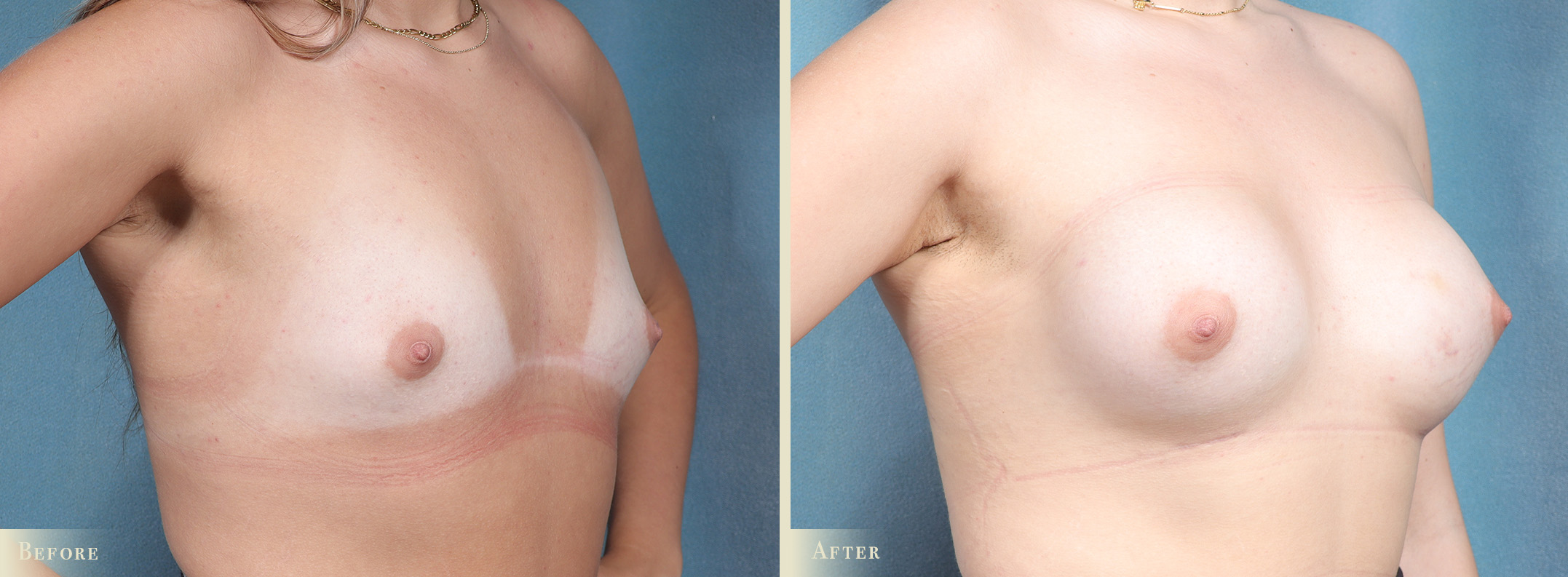 A result from Colorado Plastic Surgery