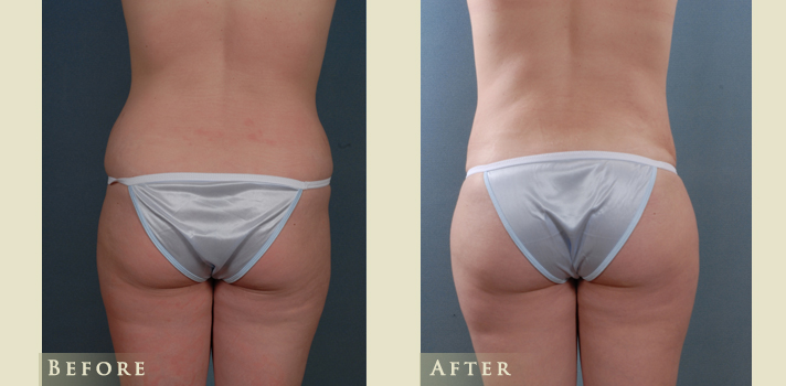 A result from Colorado Plastic Surgery