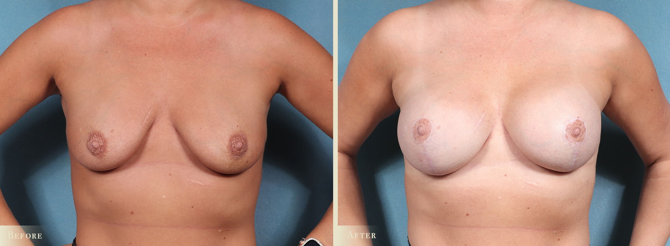 A result from Colorado Plastic Surgery