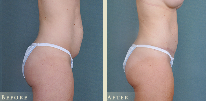 A result from Colorado Plastic Surgery
