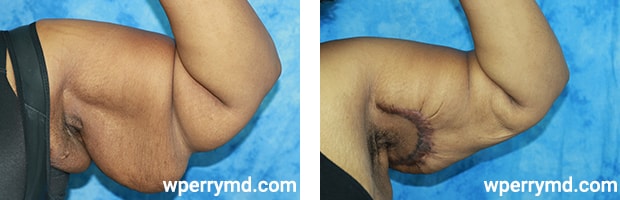 A result from Wendell C. Perry, MD