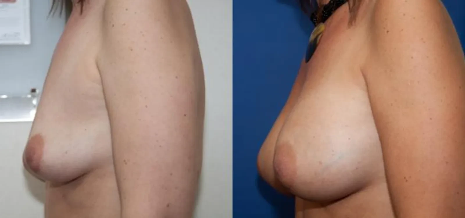 A result from Portland Plastic Surgery Group