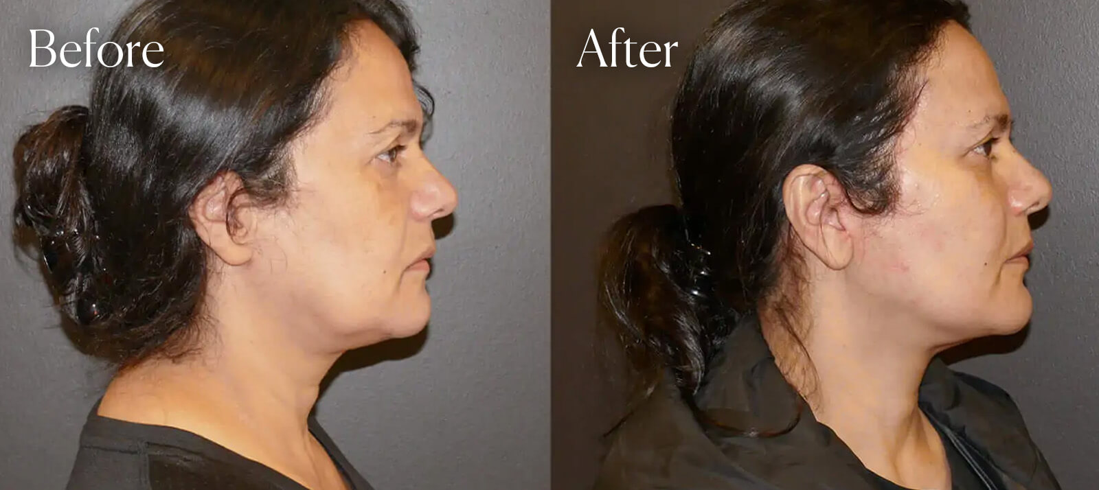A result from Shah Aesthetic Surgery - Rhinoplasty and Facelift Specialist