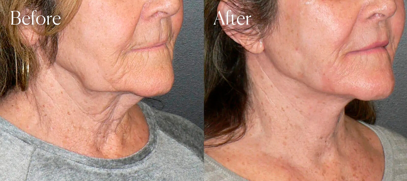 A result from Shah Aesthetic Surgery - Rhinoplasty and Facelift Specialist