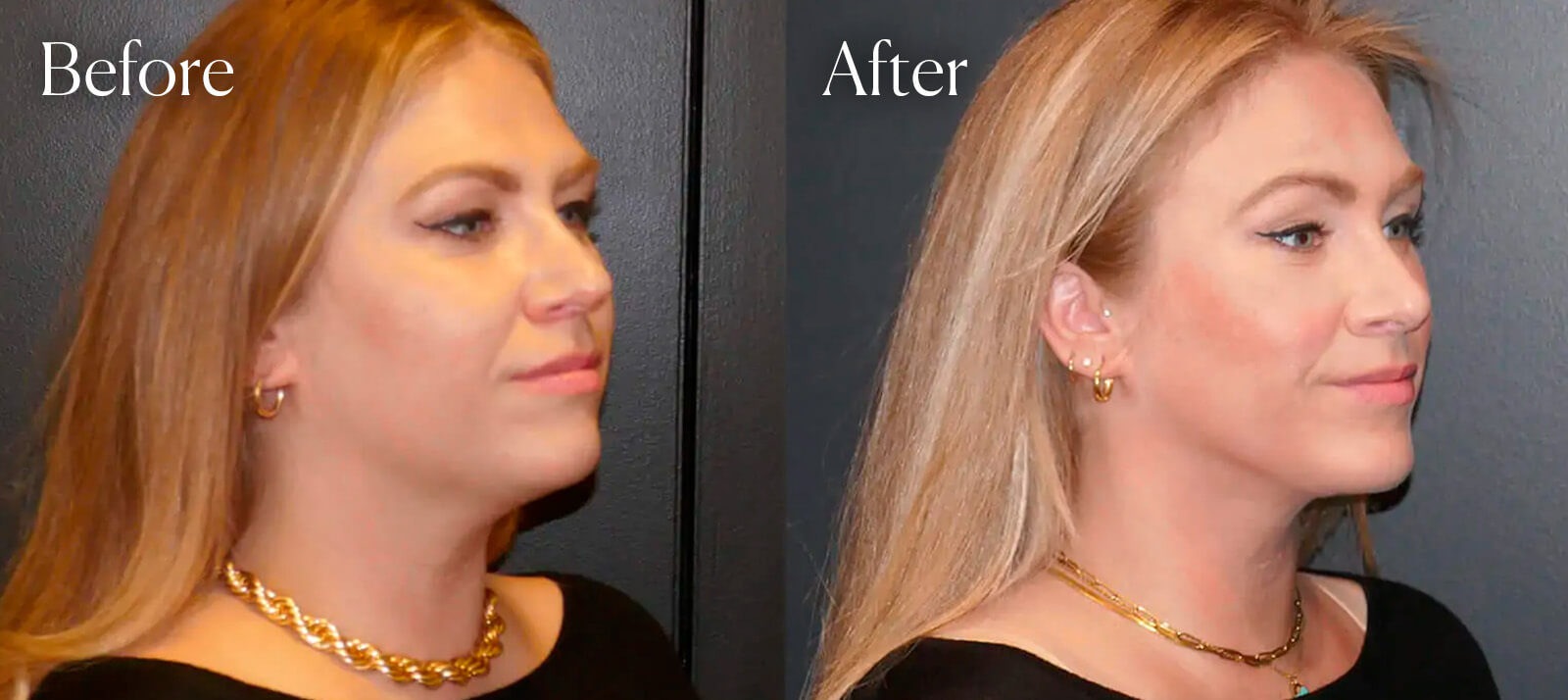 Shah Aesthetic Surgery - Rhinoplasty and Facelift Specialist provider photo