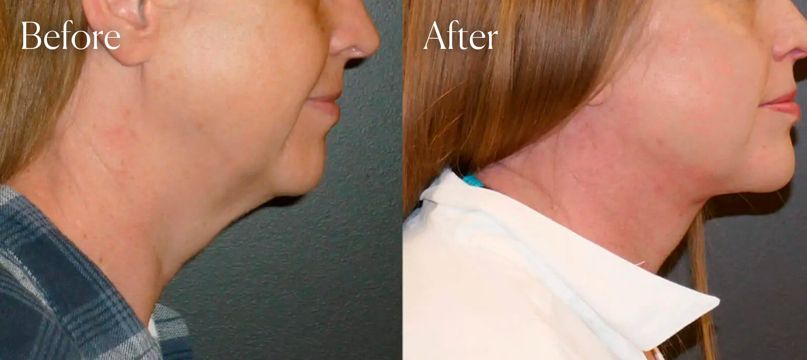 A result from Shah Aesthetic Surgery - Rhinoplasty and Facelift Specialist
