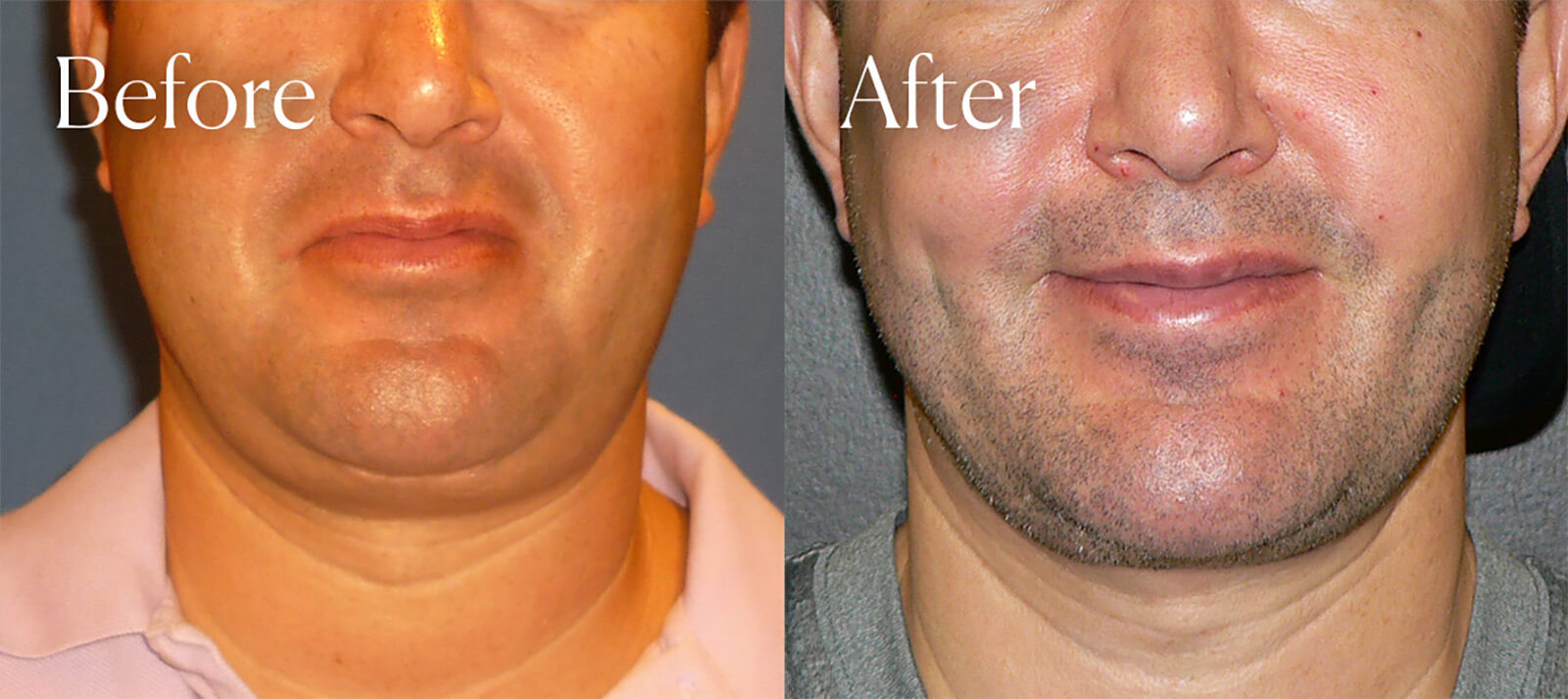 Shah Aesthetic Surgery - Rhinoplasty and Facelift Specialist provider photo