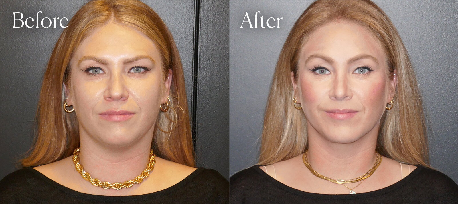 A result from Shah Aesthetic Surgery - Rhinoplasty and Facelift Specialist