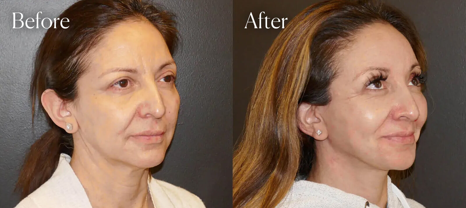 A result from Shah Aesthetic Surgery - Rhinoplasty and Facelift Specialist