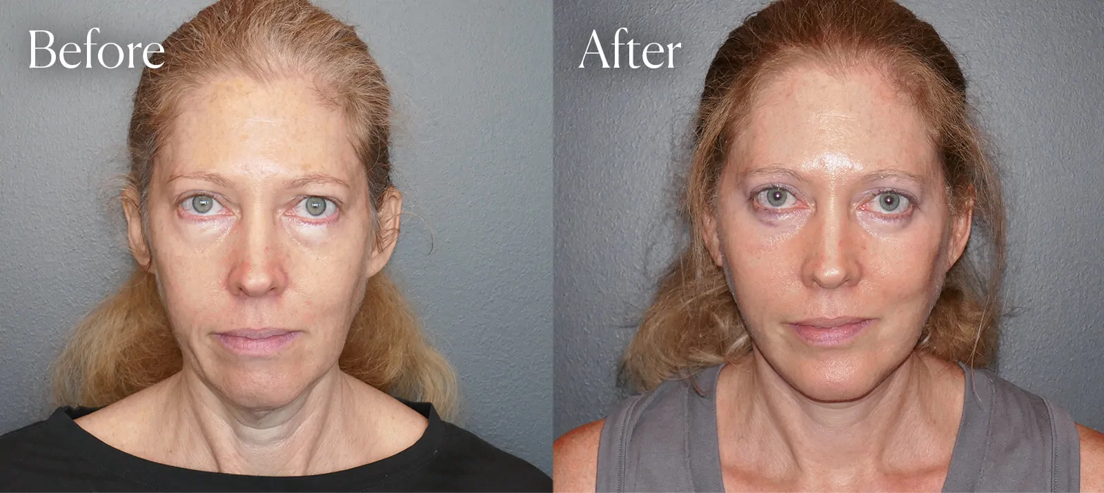 A result from Shah Aesthetic Surgery - Rhinoplasty and Facelift Specialist