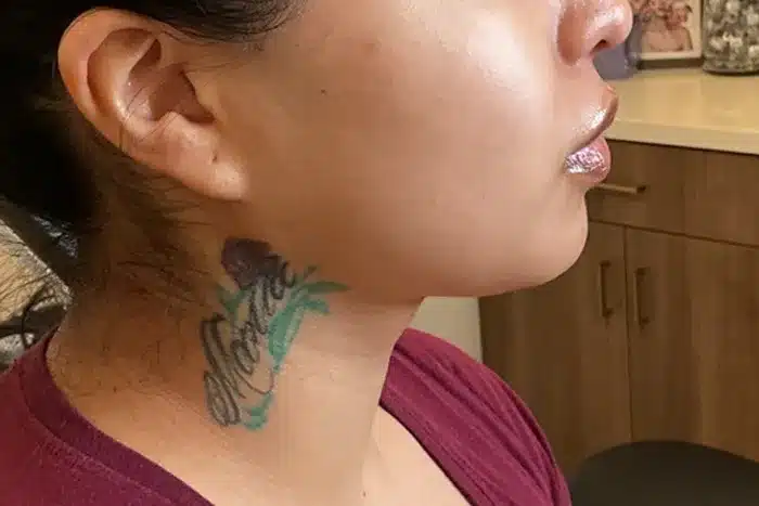Royale Aesthetics and Beauty chin implant after — Ogden, UT
