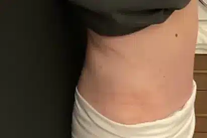 Royale Aesthetics and Beauty body contouring after — Ogden, UT
