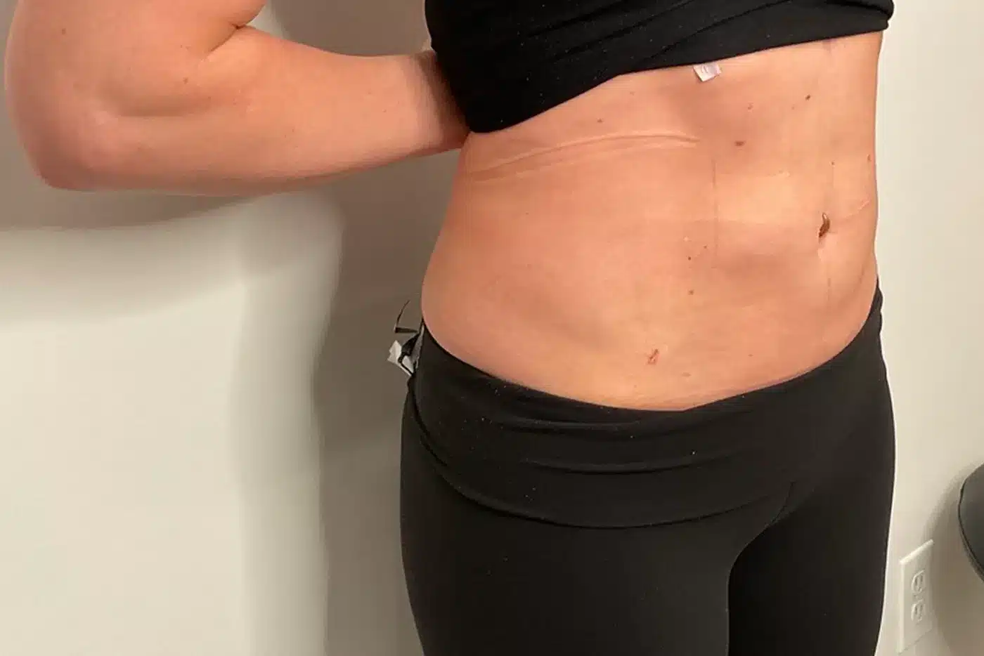 Royale Aesthetics and Beauty body contouring after — Ogden, UT