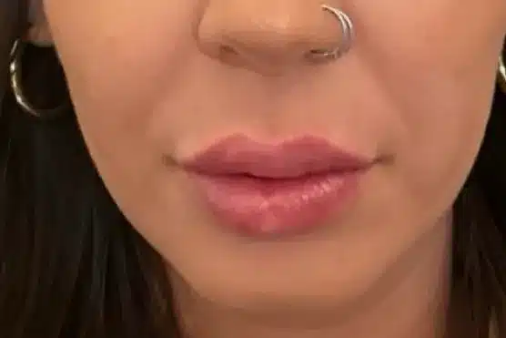 Royale Aesthetics and Beauty cheek filler after — Ogden, UT