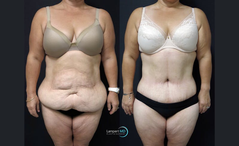 Tummy Tuck result at Dr. Joshua Lampert Plastic Surgery