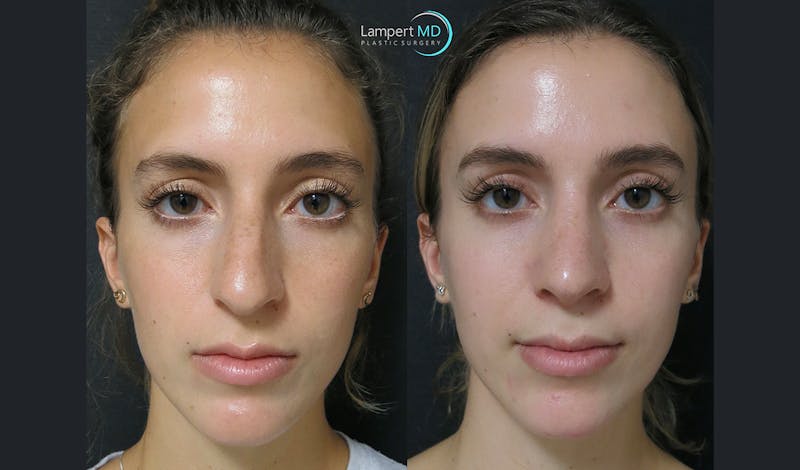 Rhinoplasty result at Dr. Joshua Lampert Plastic Surgery