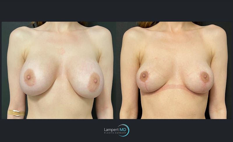 Implant Revision result at Dr. Joshua Lampert Plastic Surgery