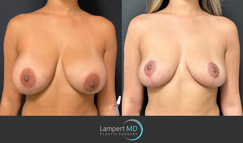 Breast Lift result at Dr. Joshua Lampert Plastic Surgery