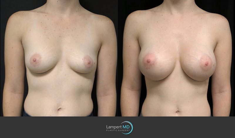 Breast Augmentation result at Dr. Joshua Lampert Plastic Surgery