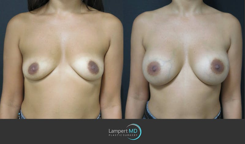 Breast Augmentation result at Dr. Joshua Lampert Plastic Surgery