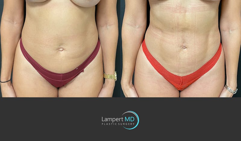 Liposuction result at Dr. Joshua Lampert Plastic Surgery